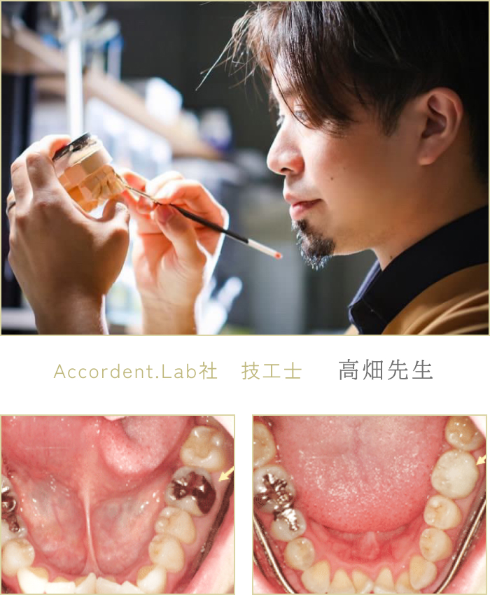 Accordent.Lab社　技工士　高畑先生 メタルフリーイメージ